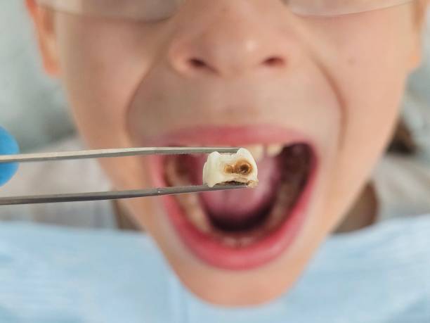 Best Pediatric Emergency Dentist in Gonzales, TX